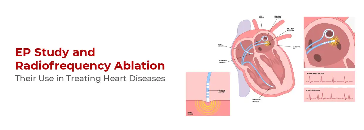 EP Study and Radiofrequency Ablation: Their Use in Treating Heart Diseases